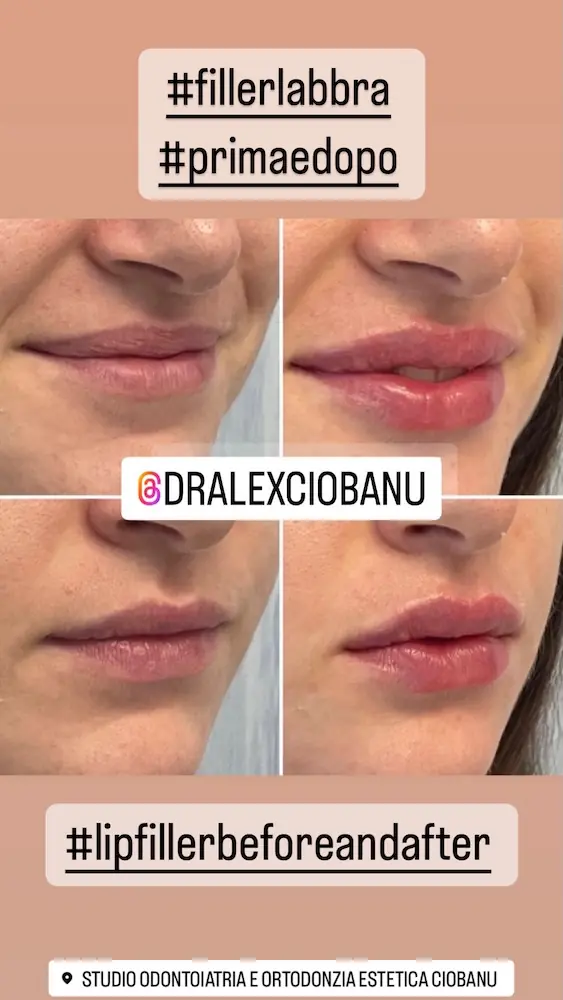 Filler Labbra Prima e Dopo