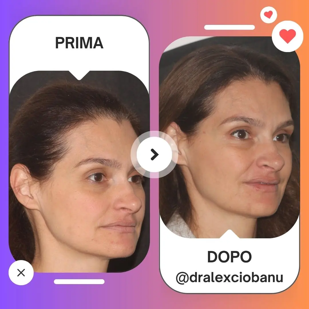 Prima e Dopo Lifting Liquido con Botox Full Face