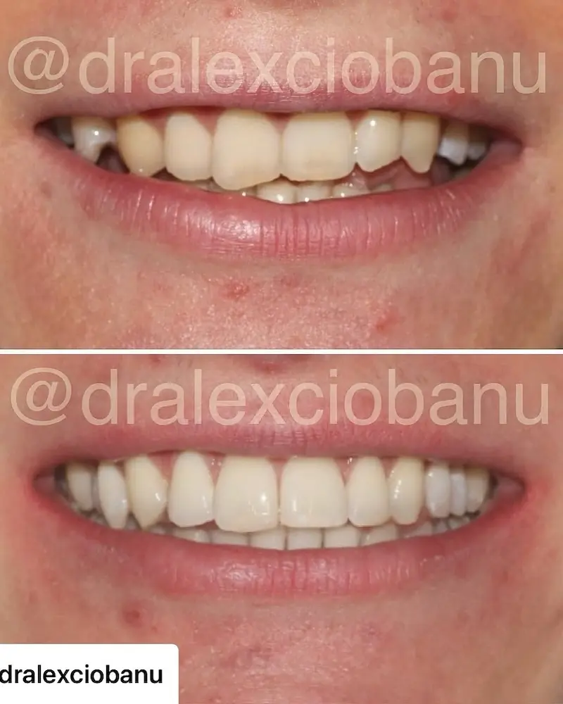 Sbiancamento Dentale Professionale Prima e Dopo