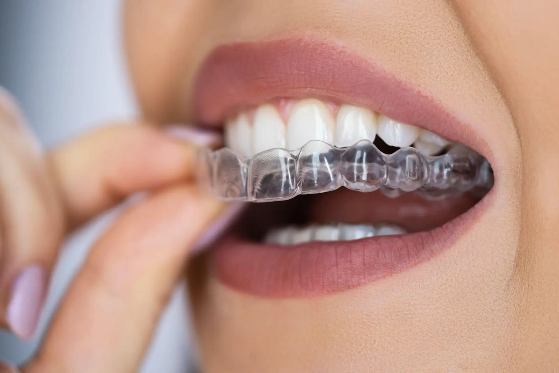 Allineatori trasparenti Invisalign