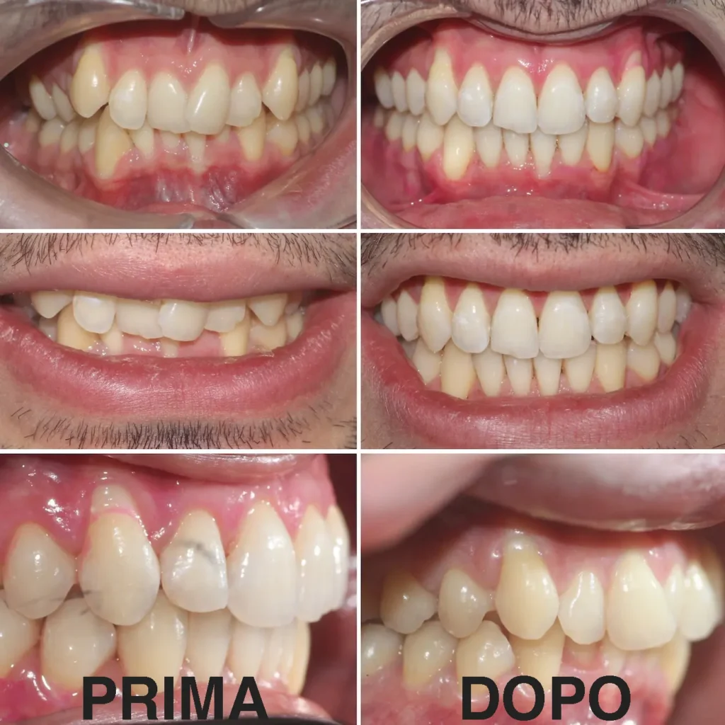 Caso clinico risolto con apparecchio linguale WIN invisibile