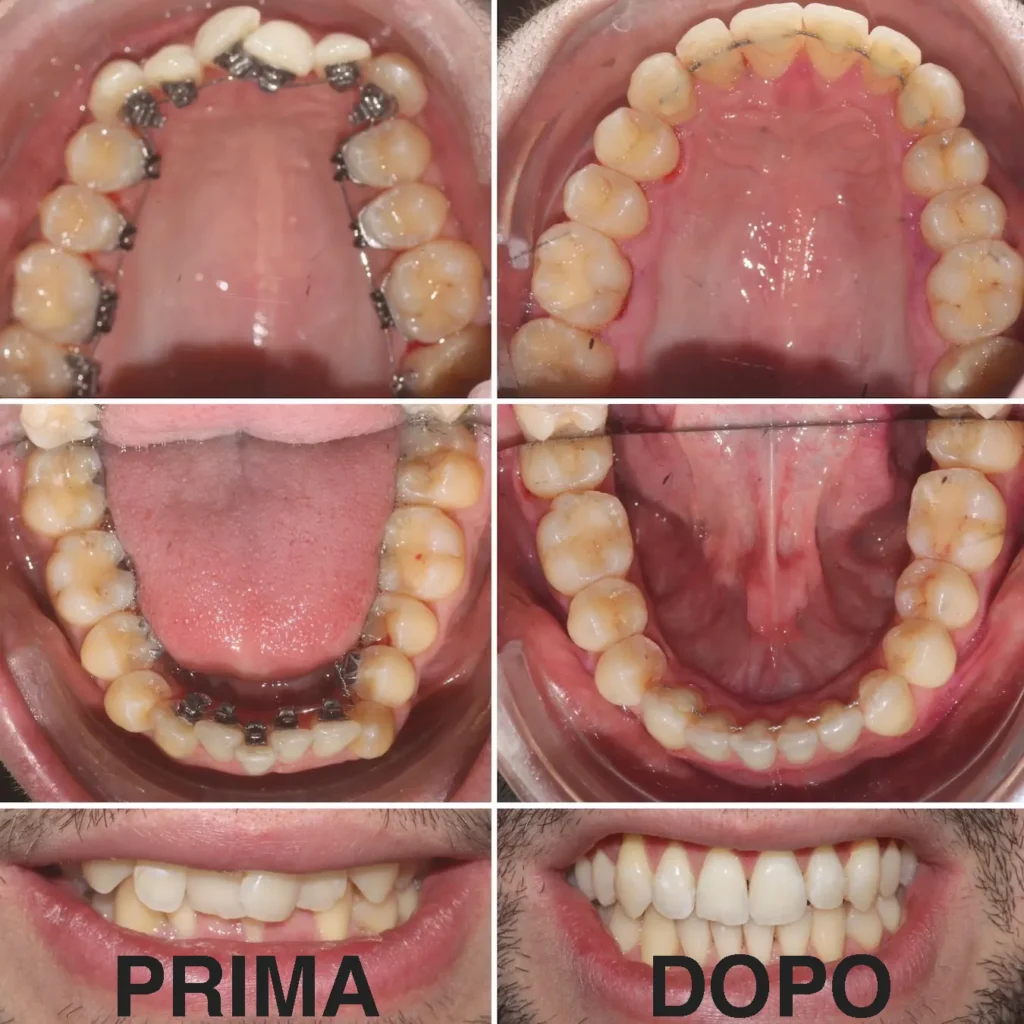 Caso clinico risolto con apparecchio linguale WIN invisibile