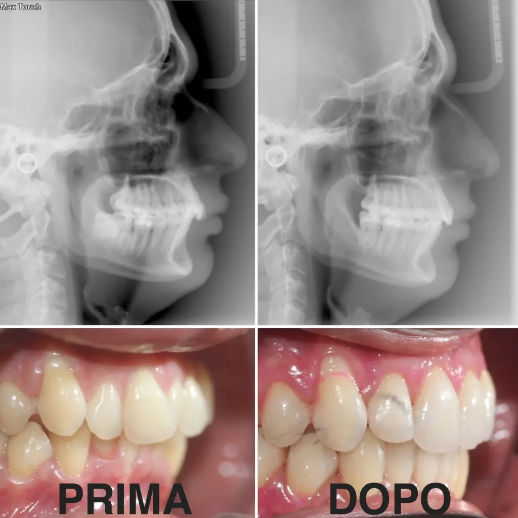 Caso clinico risolto con apparecchio linguale WIN invisibile