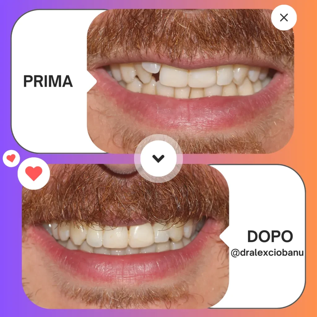 Prima - Dopo affollamento dentale
