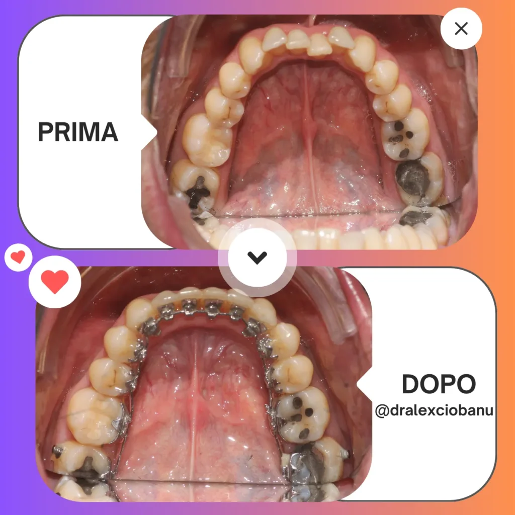 Prima - Dopo affollamento dentale