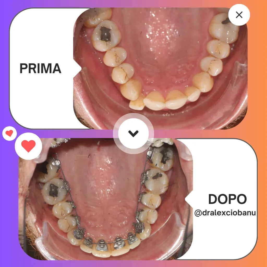 Prima - Dopo affollamento dentale