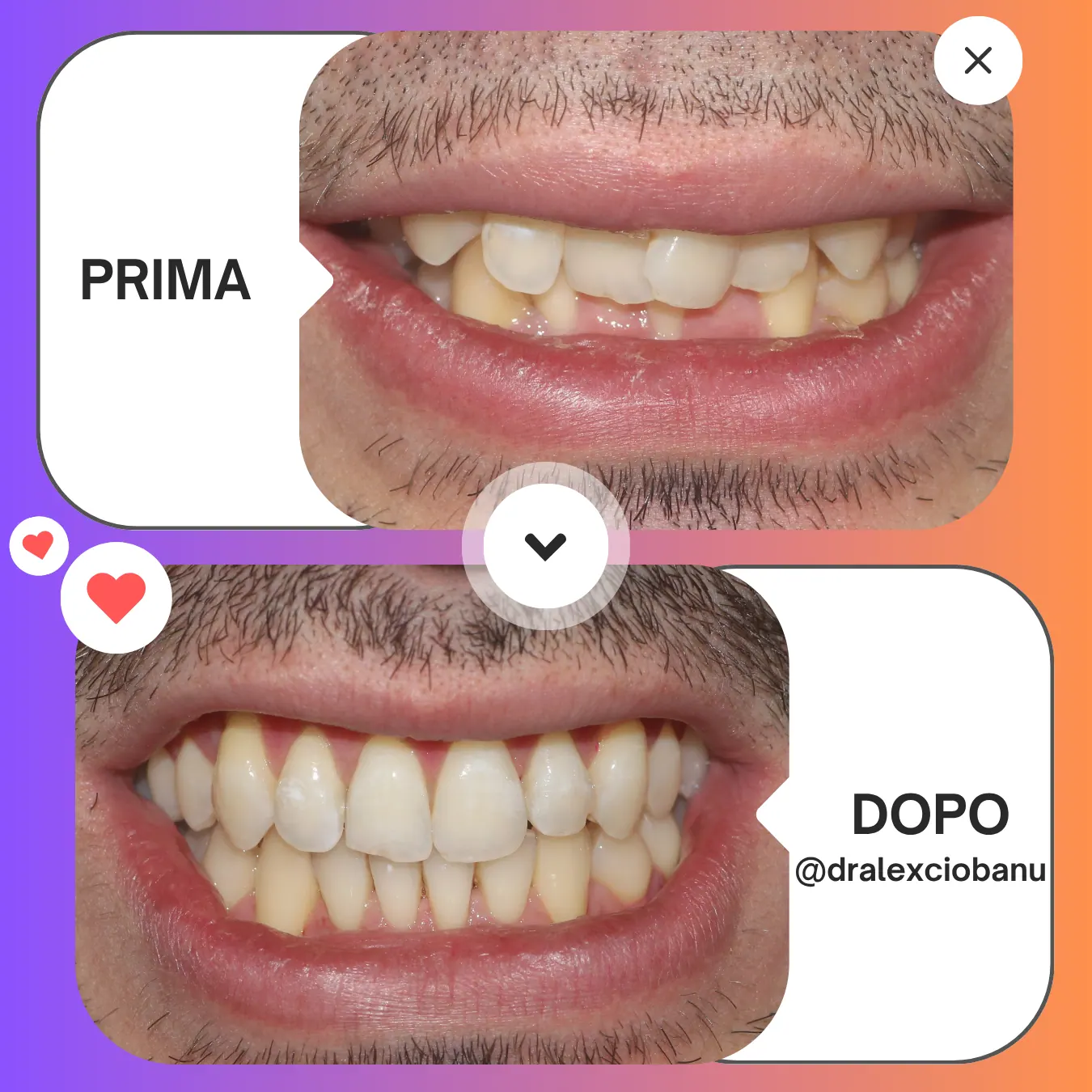 Caso clinico apparecchio linguale WIN