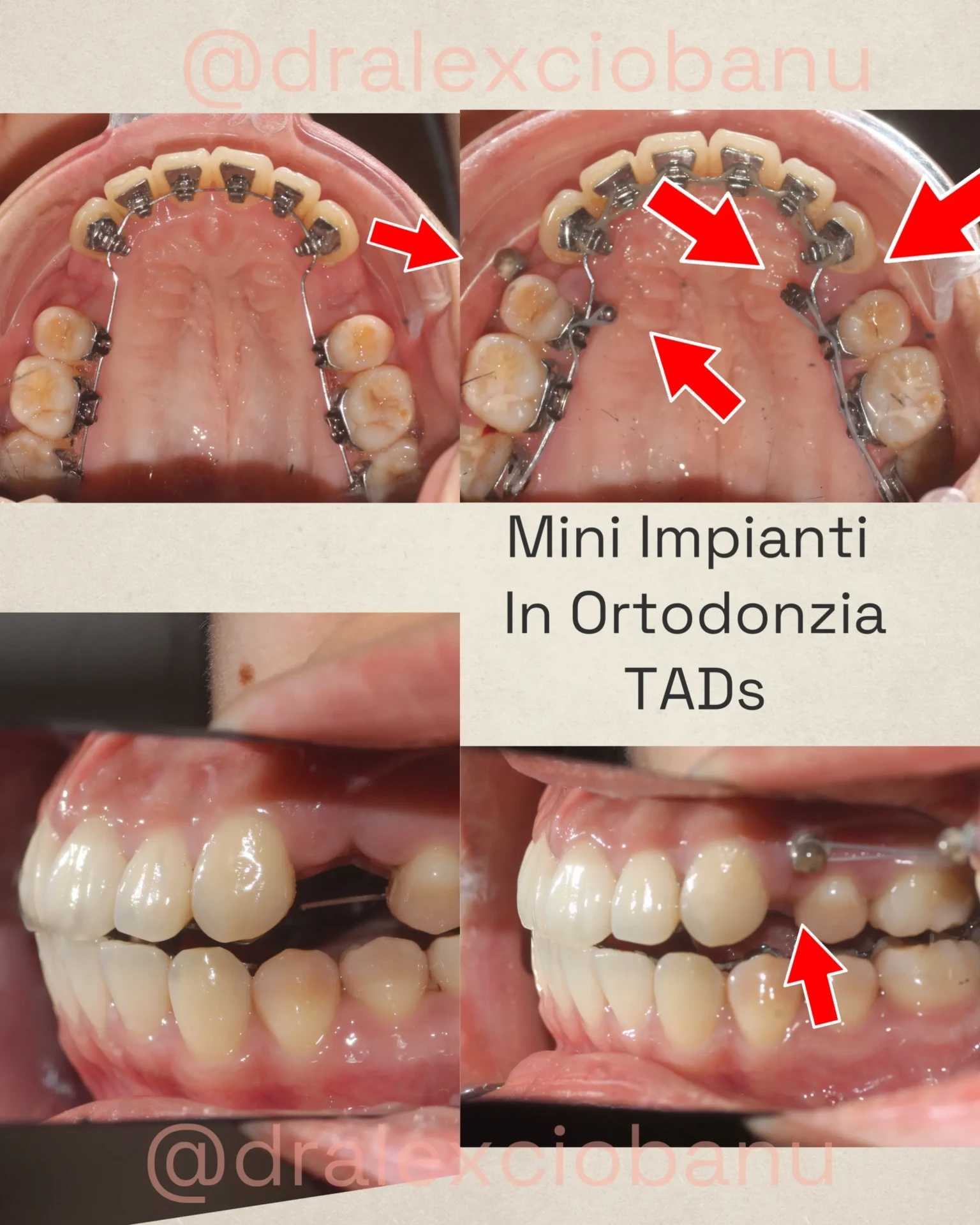Mini impianti ortodontici (TADs) a Milano