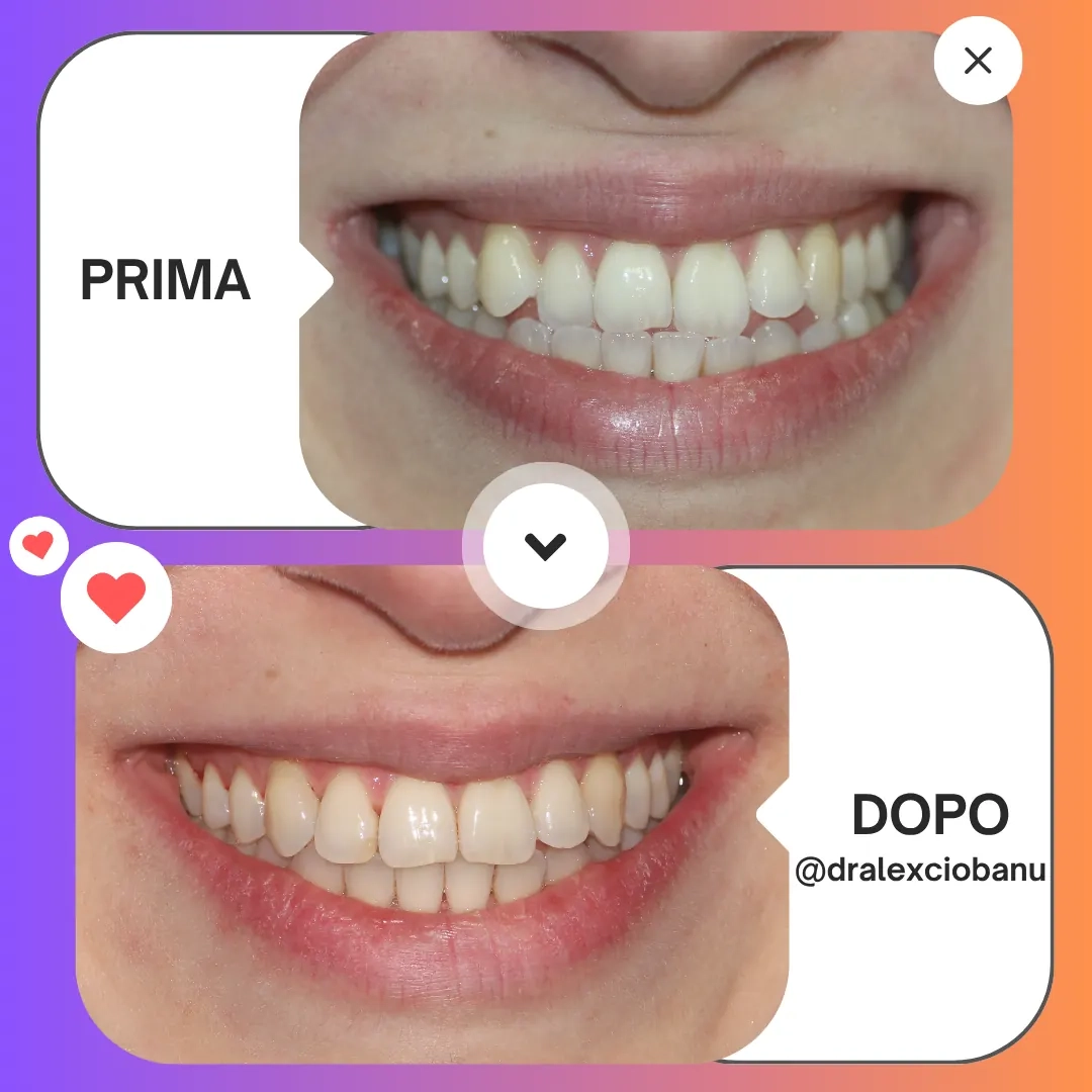Prima - Dopo Correggi morso aperto