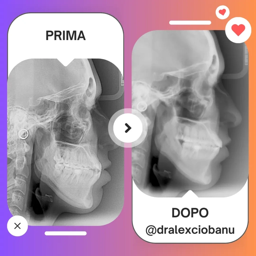 Prima - Dopo Correggi morso aperto