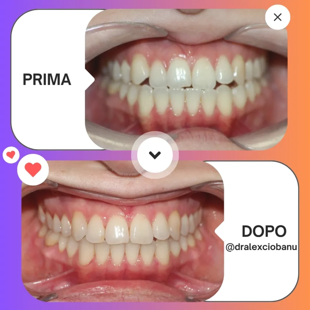 Prima - Dopo Correggi morso aperto 3