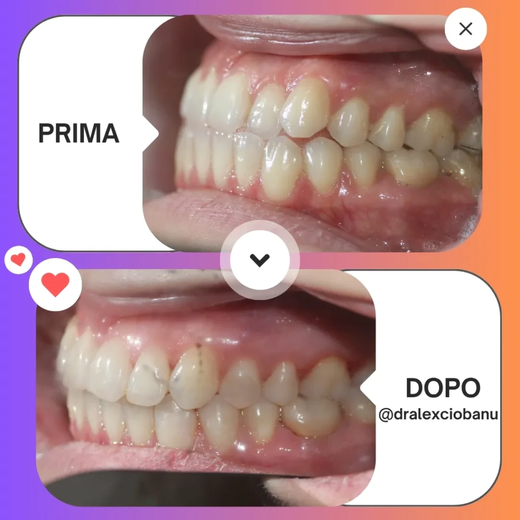 Prima - Dopo Correggi morso aperto 4