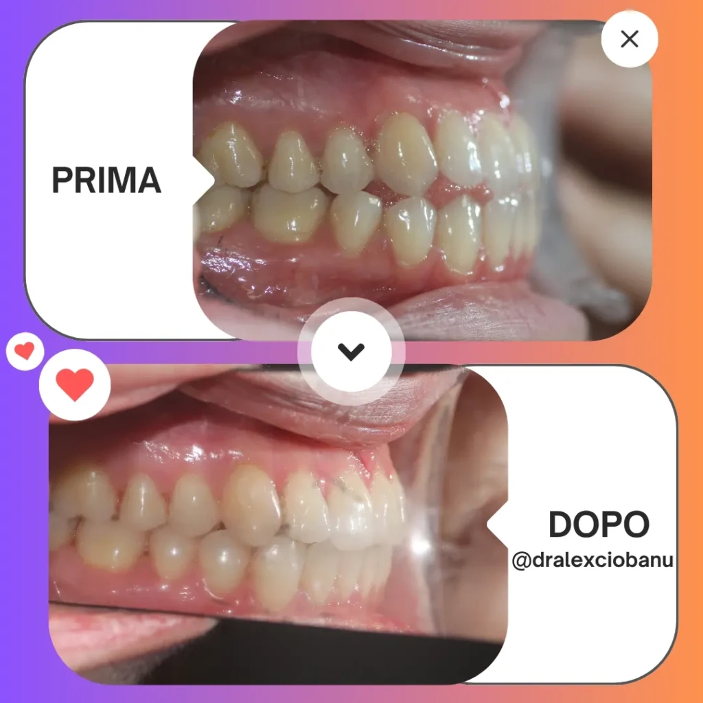 Prima - Dopo Correggi morso aperto 5