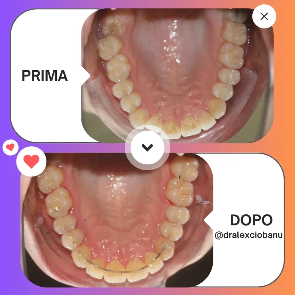 Prima - Dopo Correggi morso aperto 6