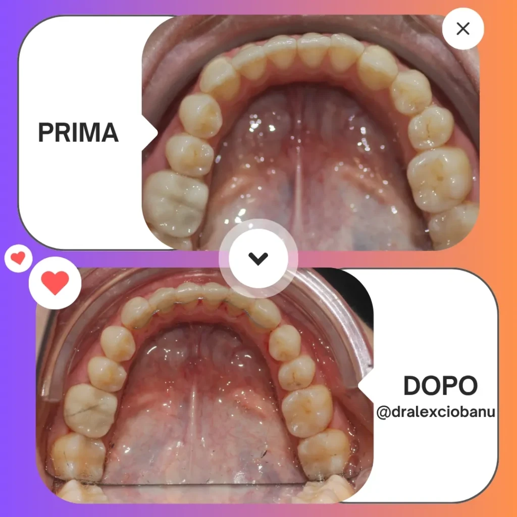 Prima - Dopo Correggi morso aperto 7